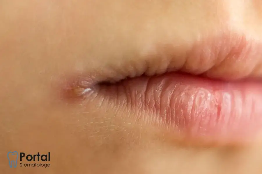 Zdjęcie Czy z zajadami można iść do dentysty? Ważne informacje i porady